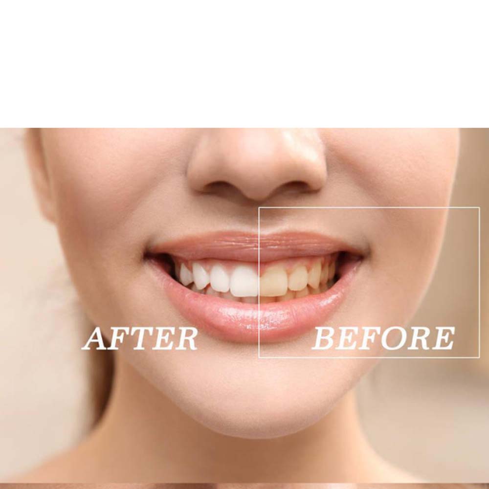 Kit de gel para clareamento de - Teeth Whitening Gels avaliação e preço