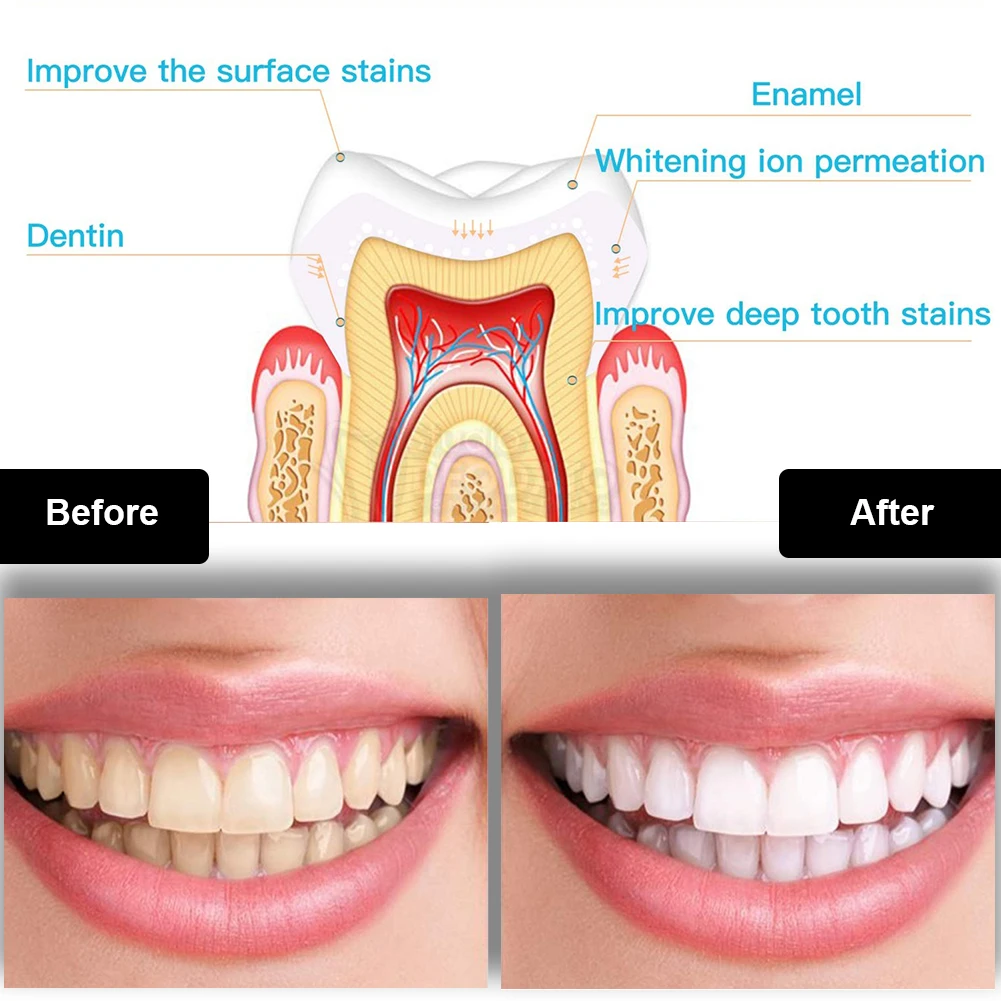 Kit de clareamento dental dos  - Teeth Whitening Gels avaliação e preço