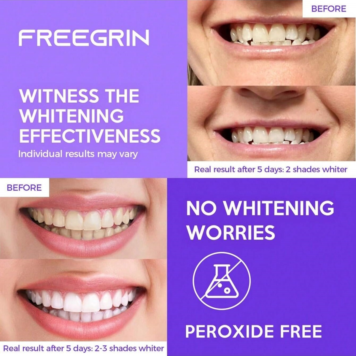 Adesivos de clareamento dental - Teeth Whitening Gels avaliação e preço